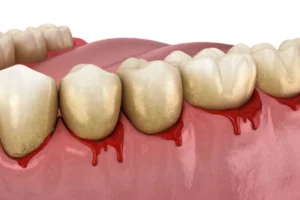 gengiva sangrando ao escovar os dentes