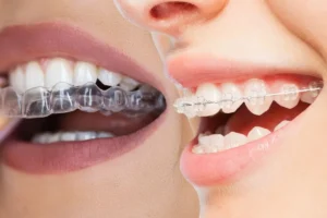 aparelho transparente vs alinhadores